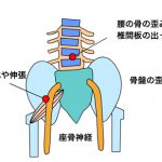 腰痛で脊柱管狭窄症の症状とは？歩行困難やしびれが悪化したら手術も検討！