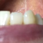 歯が抜ける原因は歯周病？虫歯を予防するフッ素に潜む危険性とは！
