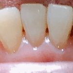 歯槽膿漏を徹底的に予防する歯磨きの4つの大きな効果とは！