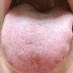 舌下免疫療法は自宅でできて痛みもなく、副作用も少ないって本当？
